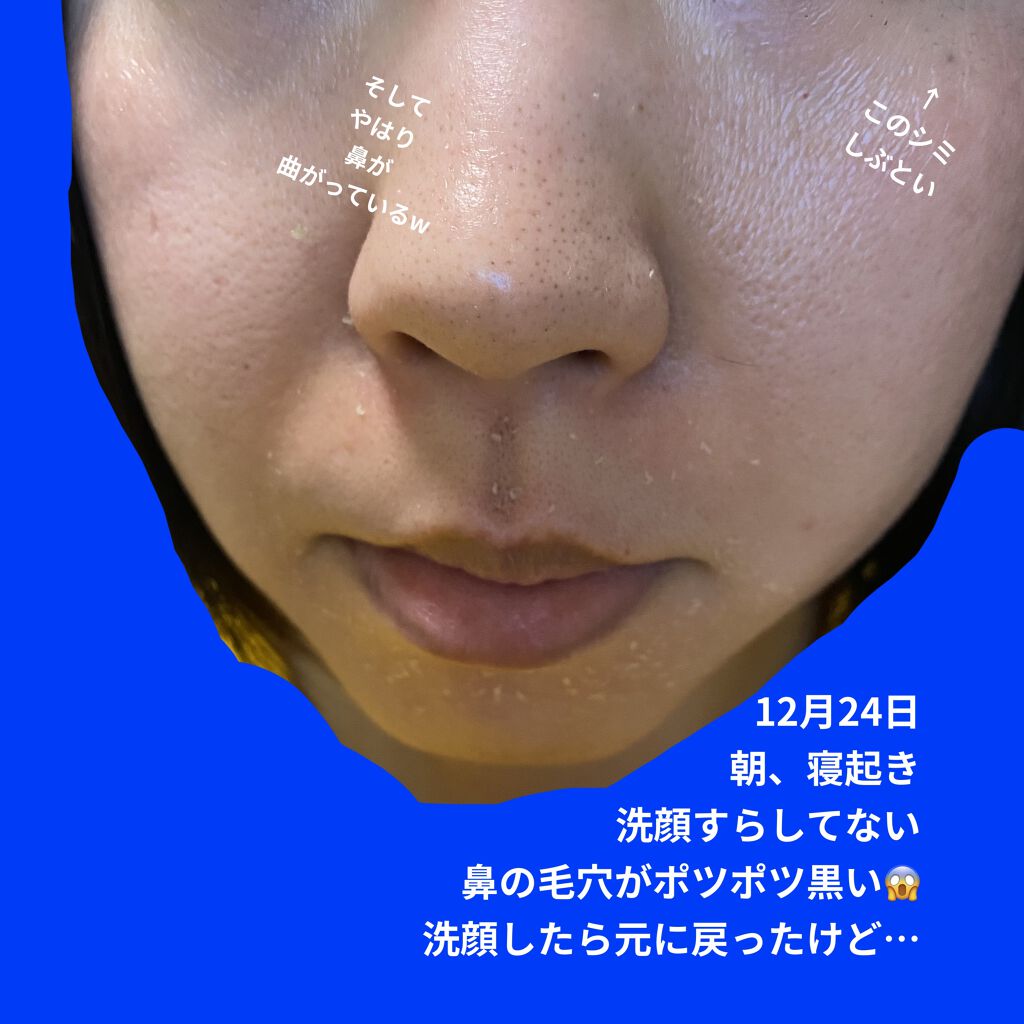 ジェントルクレンザー Zo Skin Healthの口コミ 休薬3日目 毎日投稿できてる自分えらい W By ワタクシ ブルベ冬 敏感肌 30代前半 Lips