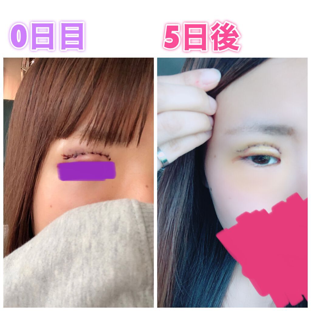 二重になる方法 アイトーク アイトークの使い方や二重メイク 二重切開について 切 By りほ 代後半 Lips
