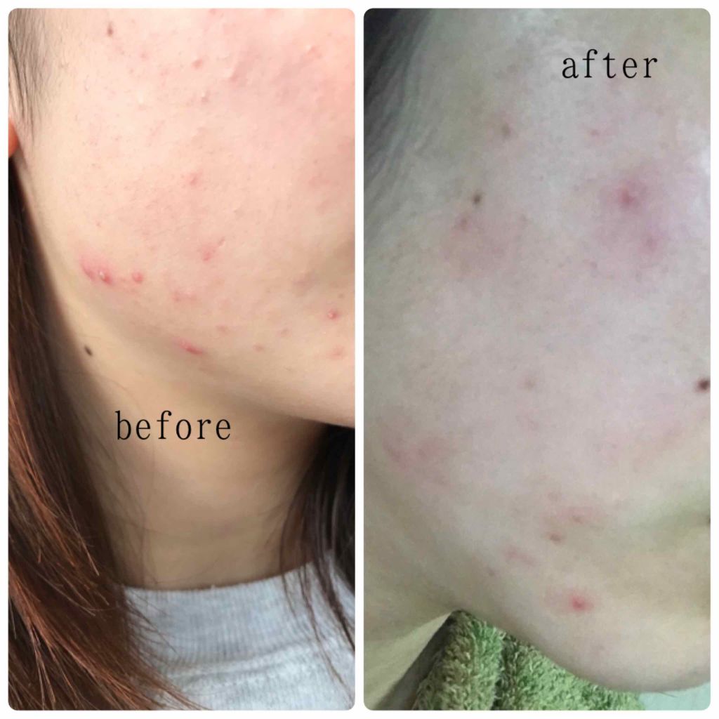 薬用 雪肌精 雪肌精の辛口レビュー 薬用雪肌精しっとりタイプ約１年半ほど使い By かうゆ 敏感肌 代前半 Lips