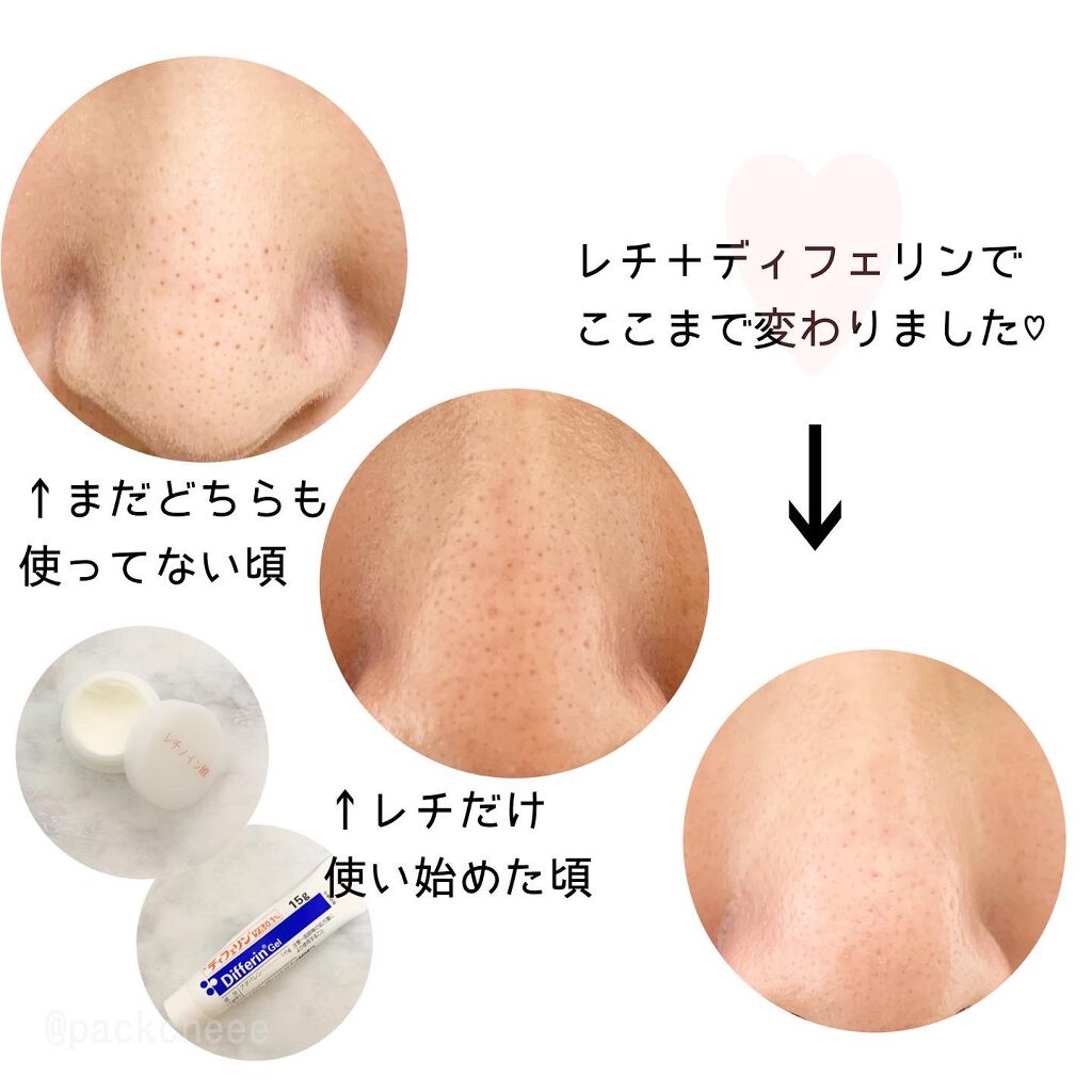 エピデュオゲル 医薬品 を使った口コミ いちご鼻経過 毛穴悩みはほんと尽き By Packcheee 混合肌 30代前半 Lips