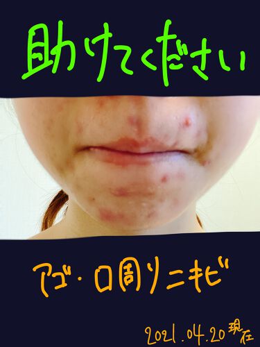 22年最新 ニキビ 口周り特集 口コミで人気の50アイテムを紹介 Lips