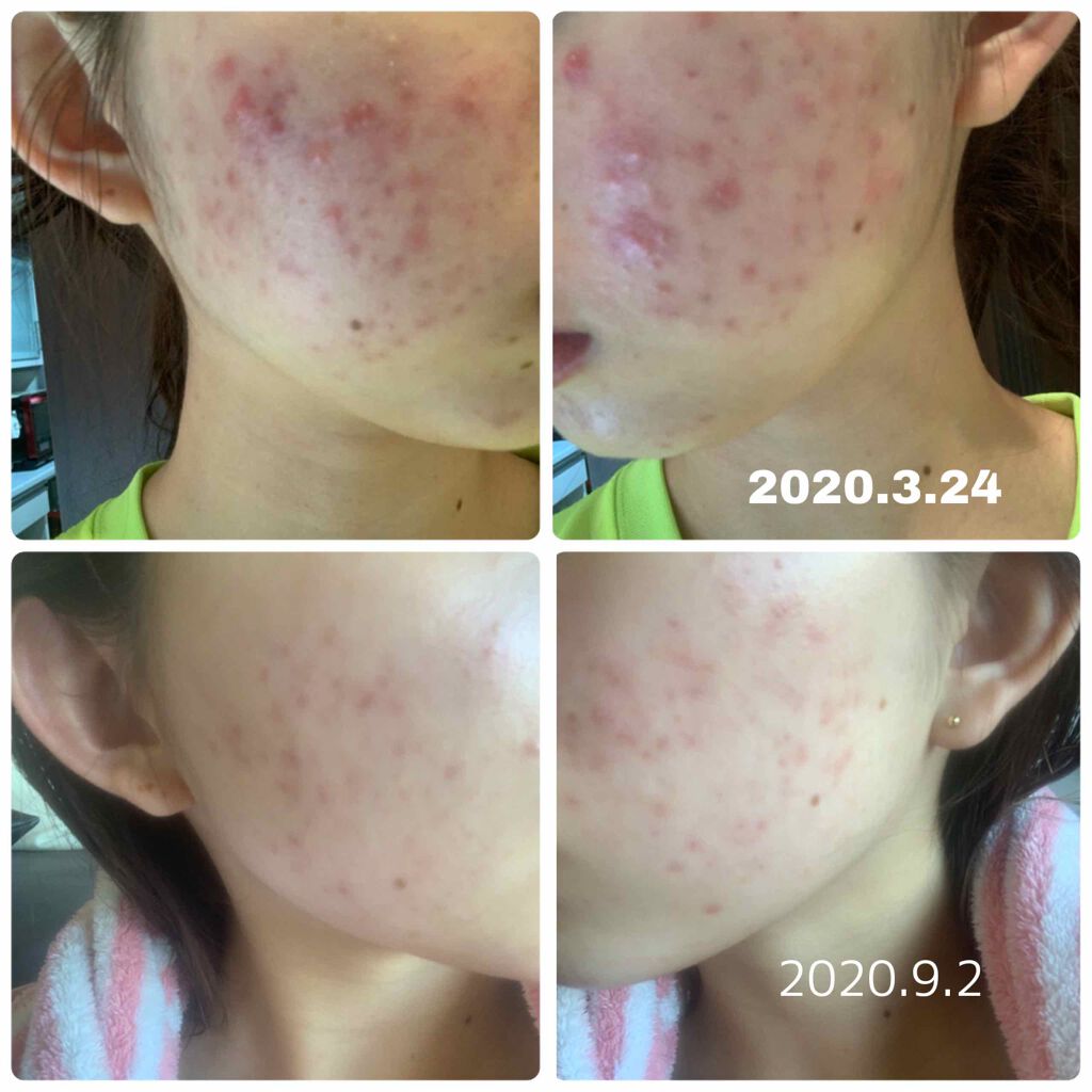 Cica デイリー スージング マスク Vt Cosmeticsを使った口コミ ニキビ 治ってきてる わーい って By ばびょんん 混合肌 10代後半 Lips