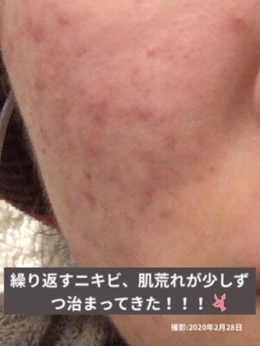 白色ワセリン 医薬品 健栄製薬の口コミ 2年前の受験期を機に ニキビが多発し ニキ By Pink Sounds S6i Lips
