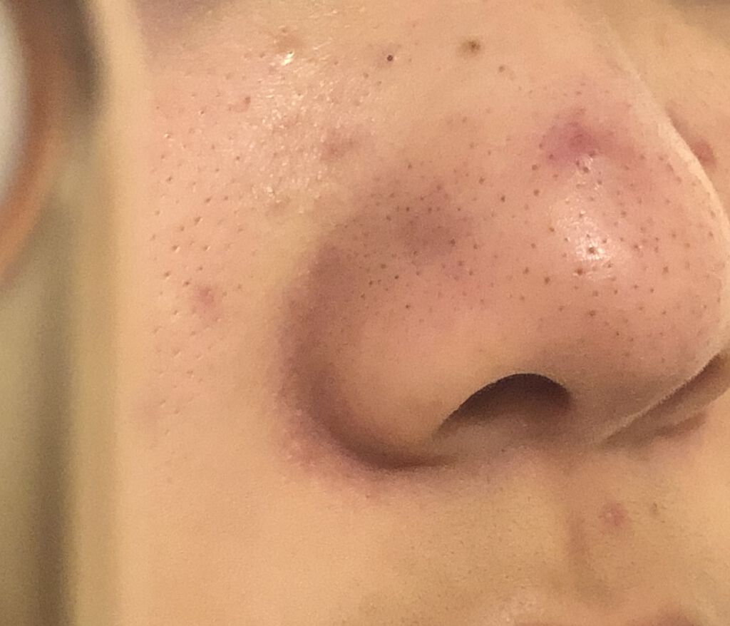 明色 美顔水 薬用化粧水 明色化粧品を使った口コミ 黒ずみ毛穴 小鼻の赤み 助けてください By Orange Sounds Uvqk 混合肌 10代前半 Lips