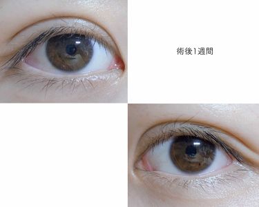 ラッシュジェリードロップ Majolica Majorcaの効果に関する口コミ はじめまして 二重の埋没施術を受け By 餅 混合肌 代前半 Lips