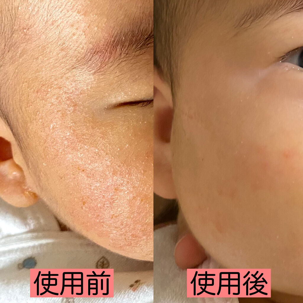 ローション キュレルを使った口コミ キュレルにかえてから子の乳児湿疹が良くなり By えんだ 相互希望です 乾燥肌 30代前半 Lips