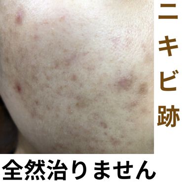 桂枝茯苓丸加ヨクイニン 医薬品 ツムラを使った口コミ ごめんなさい こんな汚い肌表紙にして ニキ By にきびちゃん 代後半 Lips