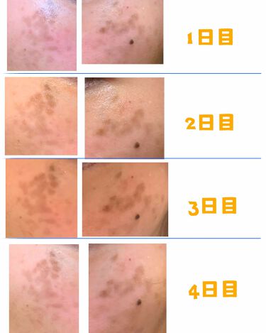 メラノキュア Hq グラファの効果に関する口コミ こちらは皮膚科での処方 ハイドロキノンの軟 By Miz Lips