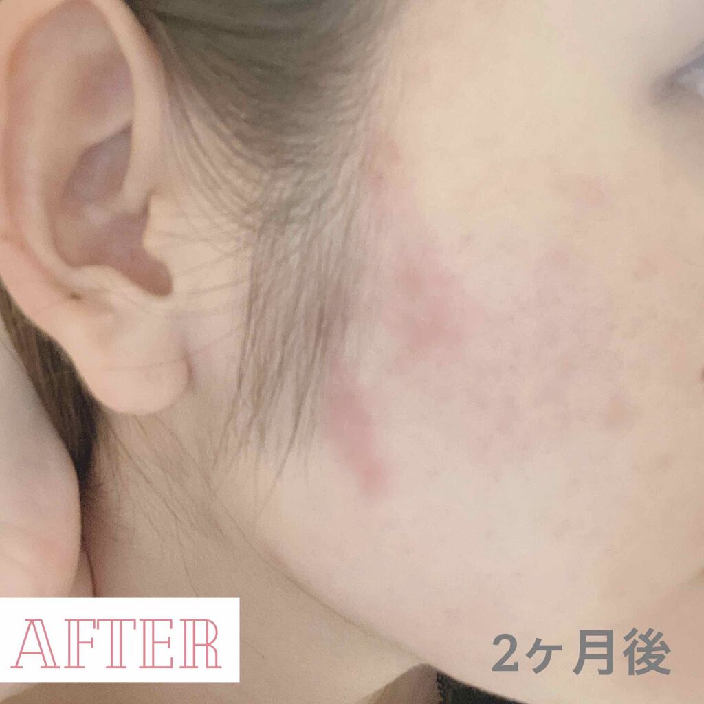 Cream Care Of Cica Tipiの効果に関する口コミ 汚肌写真あり注意 Tipiのシカクリーム By あーる 敏感肌 代前半 Lips