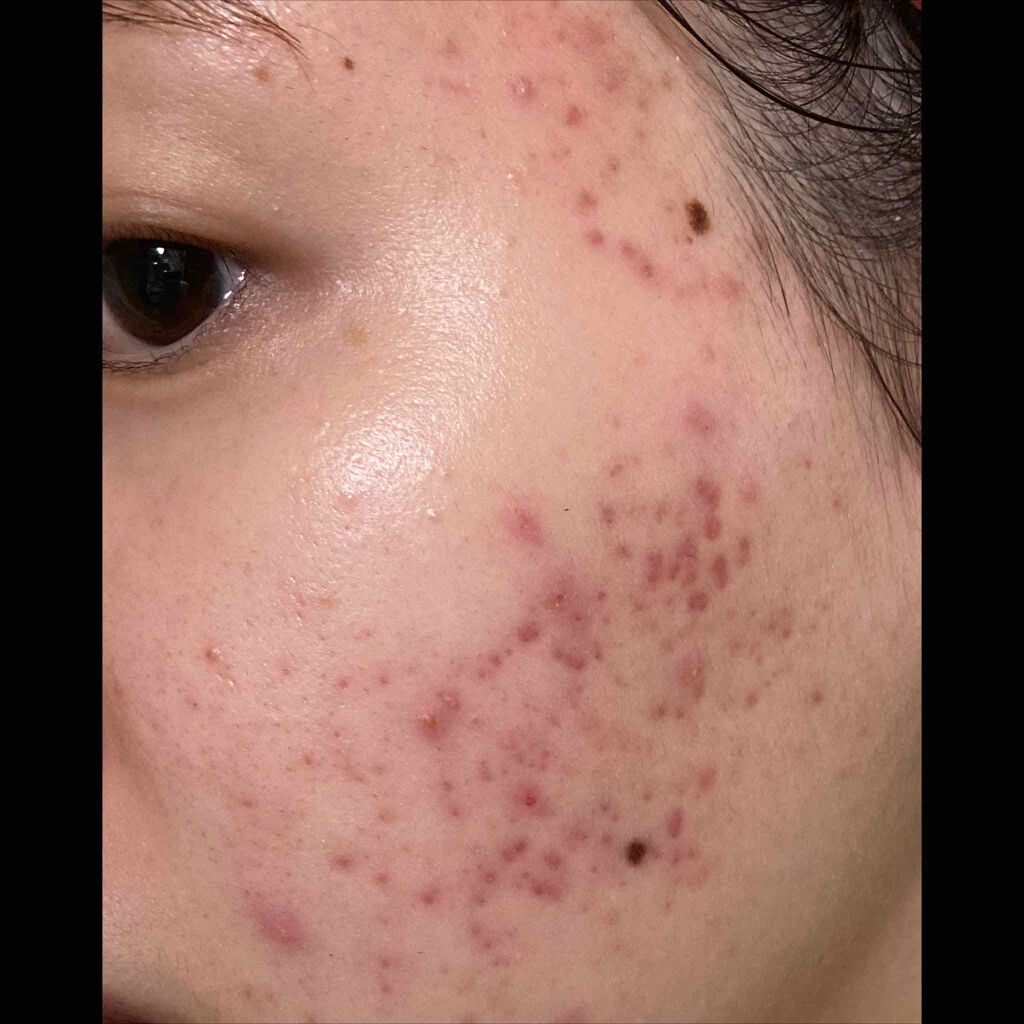 ミノン アミノモイスト 敏感肌 混合肌ライン トライアルセット ミノンの口コミ 白いプツプツが出来てスキンケア中とかに潰れ By U 敏感肌 20代前半 Lips