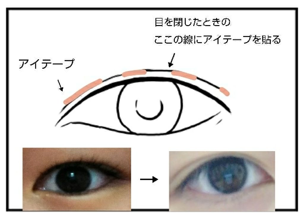 二重になる方法 のび る アイテープ 絆創膏タイプ Daisoの使い方や二重メイク 気付けばもうすぐクリス By ありたそをぅ 敏感肌 10代後半 Lips