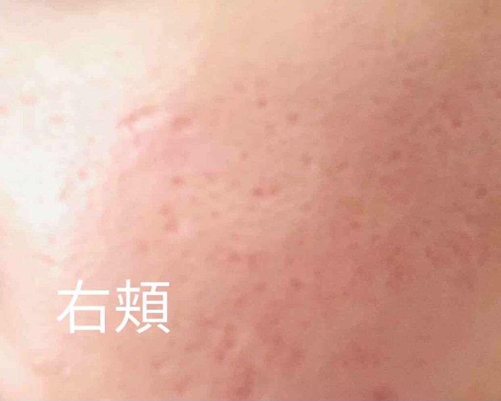マキロンs 医薬品 マキロンを使った口コミ クレーター治療備忘録 ダーマペンの使用につ By 月面探査 混合肌 Lips