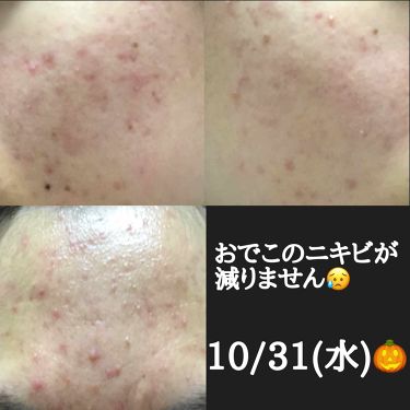 フタアミンhiクリーム ムサシノ製薬を使った口コミ ニキビ滅亡プロジェクトpart3です テス By あい 混合肌 10代後半 Lips