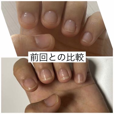 ネイルホリック ネイルホリックを使った口コミ ぱななの爪伸ばし日記最初の投稿から2週間 By ぱなな 脂性肌 代前半 Lips