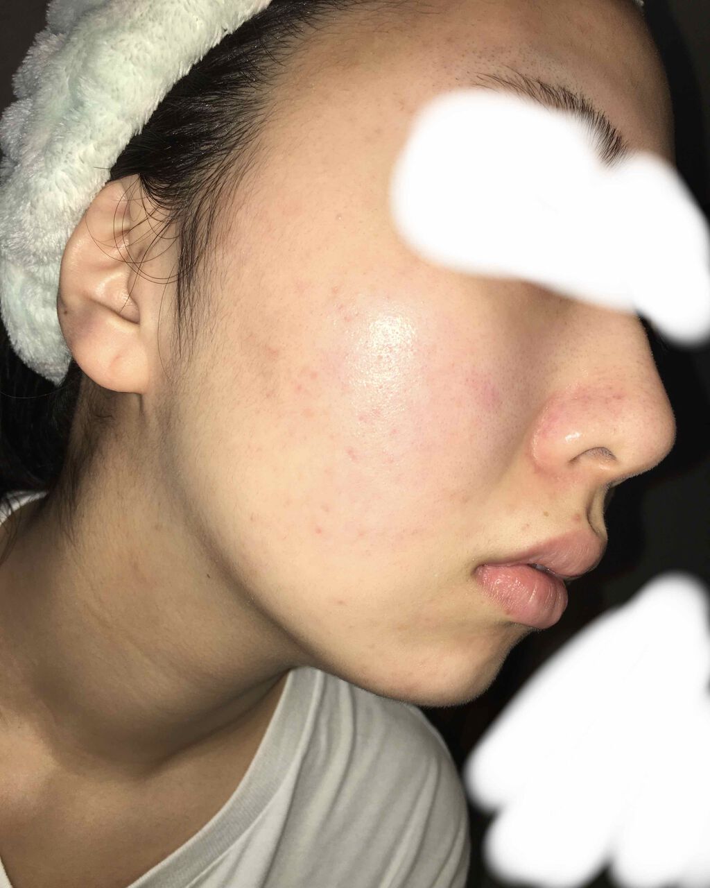 デュアック配合ゲル 医薬品 ポーラファルマの口コミ ニキビ跡に効くもの教えてください 最近の肌 By フワフワネコチャン 乾燥肌 10代後半 Lips