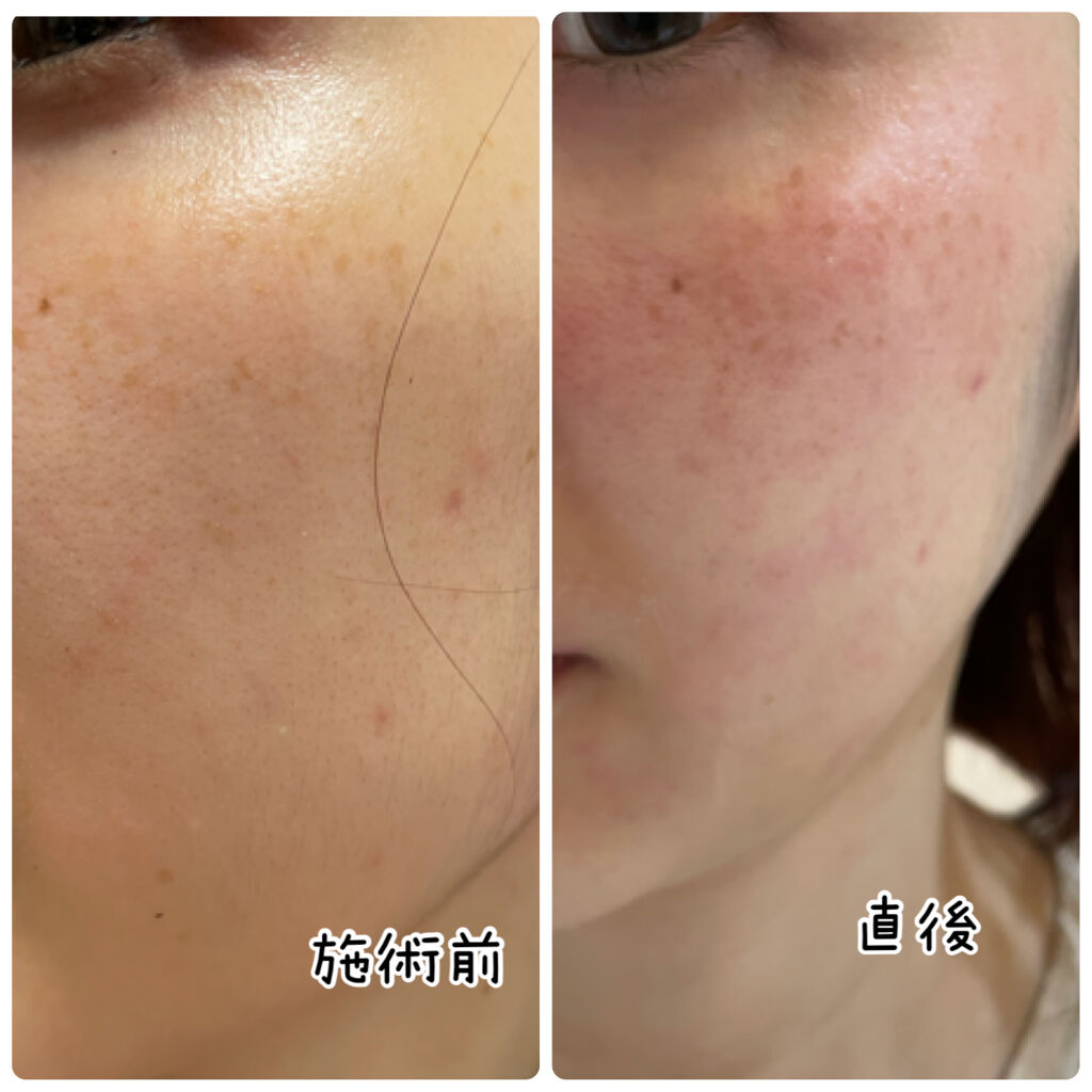 フローラドリップ Albionの口コミ ニキビ跡 毛穴で悩んでる人集まれー By アラサーaさん 乾燥肌 代後半 Lips