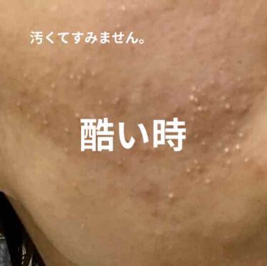 スキンケア方法 化粧水 敏感肌用 高保湿タイプ 無印良品の使い方 効果 汚い肌をいきなりすみま By 敏感肌 代前半 Lips