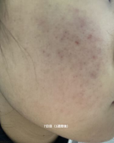 白色ワセリン 医薬品 健栄製薬の口コミ 1週間でニキビ跡が薄くなった 白色ワセ By Orange Lips Nez 10代前半 Lips