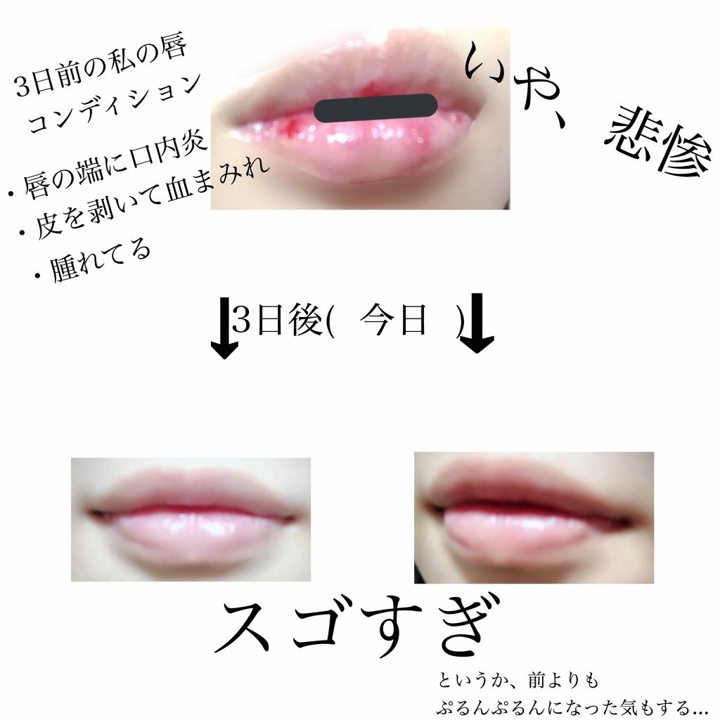 モアリップ N 医薬品 Shiseidoの口コミ 2枚目 本気で荒れてる唇の写真がありま By からあげ アトピー肌 Lips