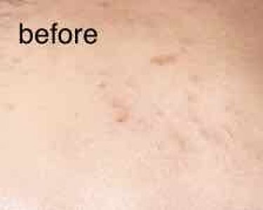 タカミスキンピール タカミの口コミ ニキビ跡抹殺法 ニキビ跡 いつまで経っても By りんか 普通肌 10代前半 Lips