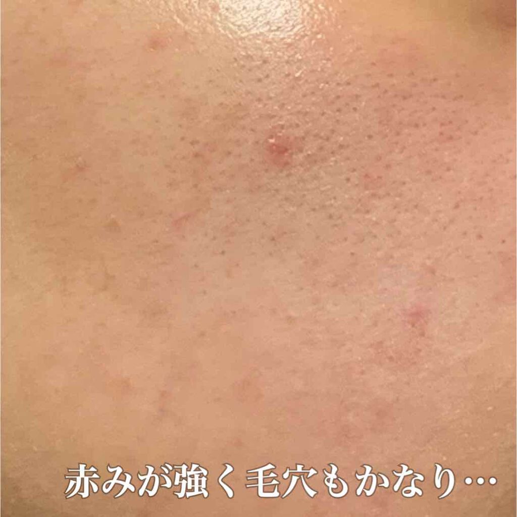 メイベリン フィットミー リキッドファンデーション R Maybelline New Yorkの色味は 色選びの参考になる口コミ 乾燥肌におすすめのリキッドファンデーション カバー力とツヤ感半端な By ぴくみょん 敏感肌 20代前半 Lips