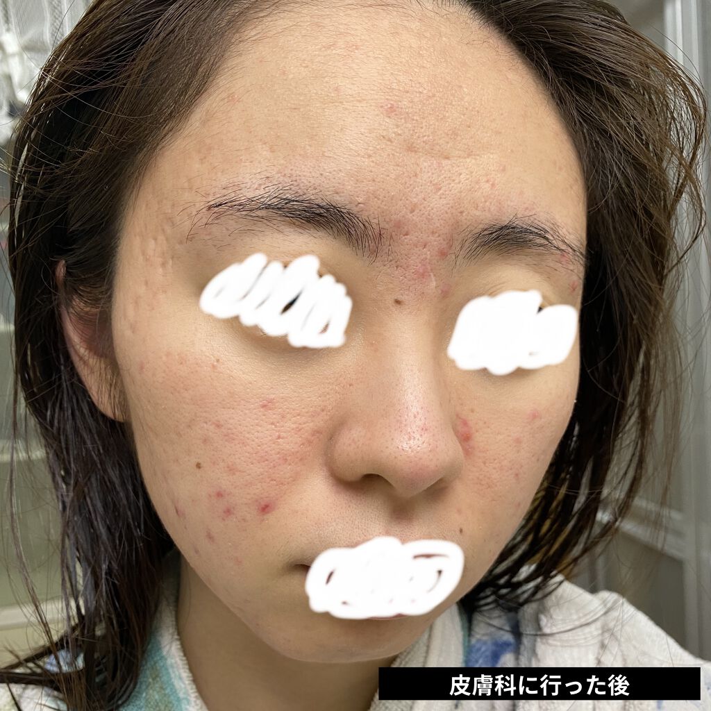 リペアソープ コラージュの口コミ 乾燥肌におすすめの洗顔石鹸 肌荒れがひどい人は一度 By かばお 混合肌 20代前半 Lips