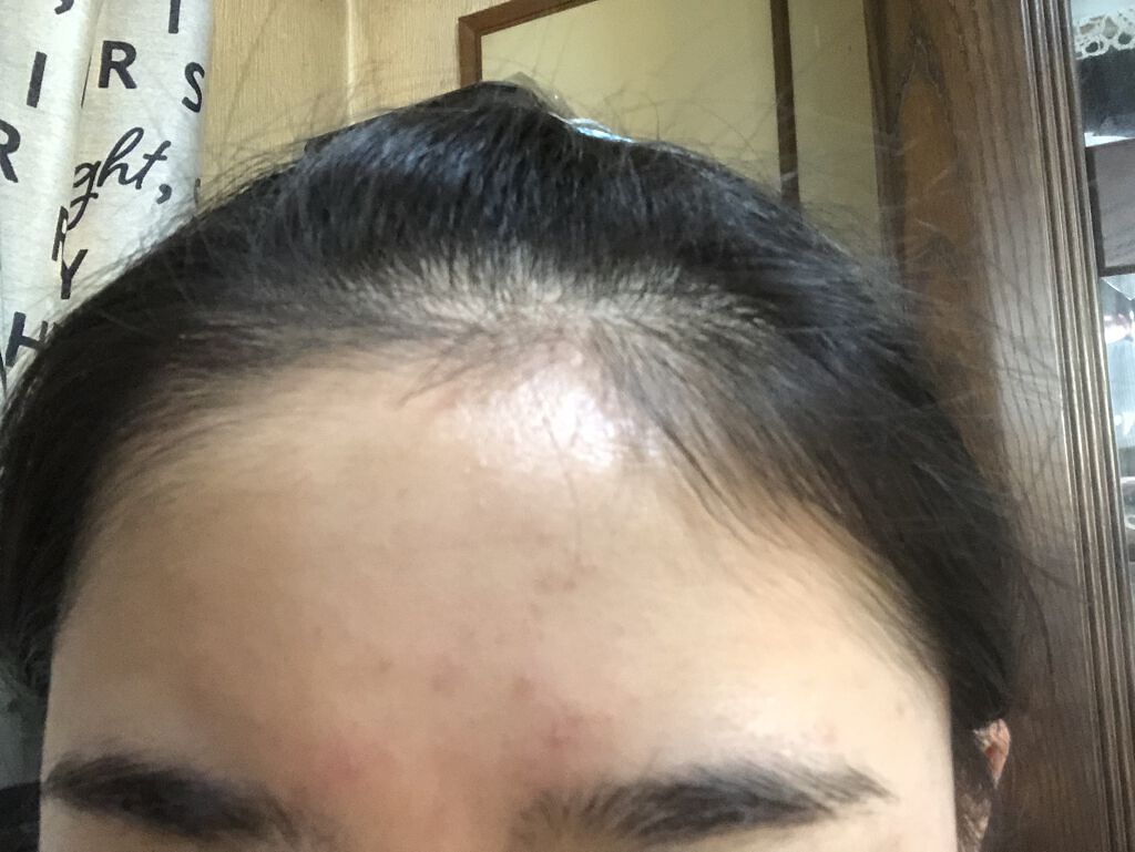 薬用しみ対策 美白化粧水 メンソレータム メラノccを使った口コミ みなさん聞いてください ほぼニキビがない By わたあめ アトピー肌 10代前半 Lips