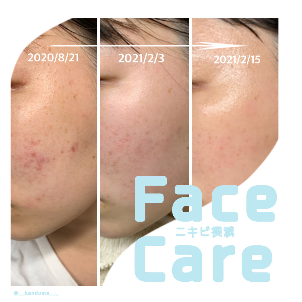 スキンケア方法 オードムーゲ 薬用ローション ふきとり化粧水 オードムーゲの使い方 効果 ニキビ撲滅 By ツナ 混合肌 代前半 Lips