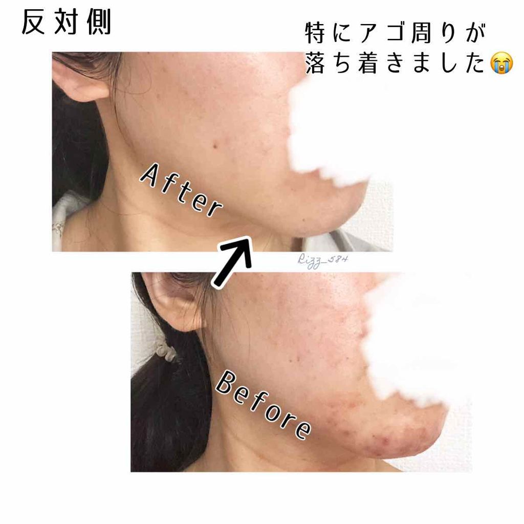 ａ アクネジェル Novを使った口コミ 肌荒れ治療日記vol 2 １枚目から汚い By Rizz 敏感肌 Lips