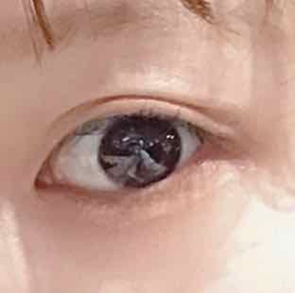 のび る アイテープ 絆創膏タイプ Daisoを使った口コミ のびーるアイテープバレない使い方 びよーん By マ 混合肌 Lips