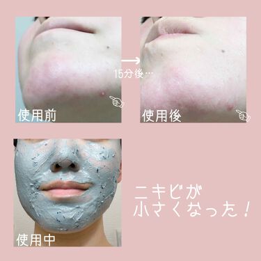 ベリーお元気 ラッシュの使い方を徹底解説 ニキビ肌の救世主 By 菜の花 混合肌 代後半 Lips