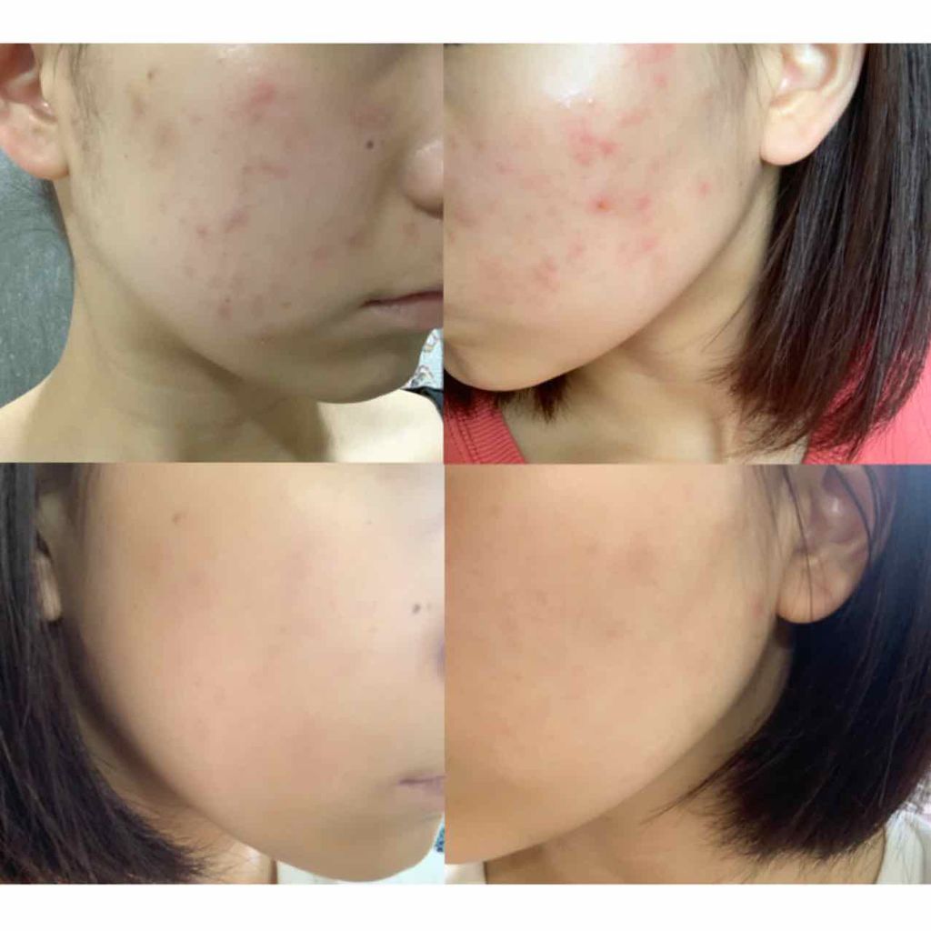 スキンケア方法 クリアデイケアベース Orbisの使い方 効果 2枚目閲覧注意 わた By もな アトピー肌 代前半 Lips