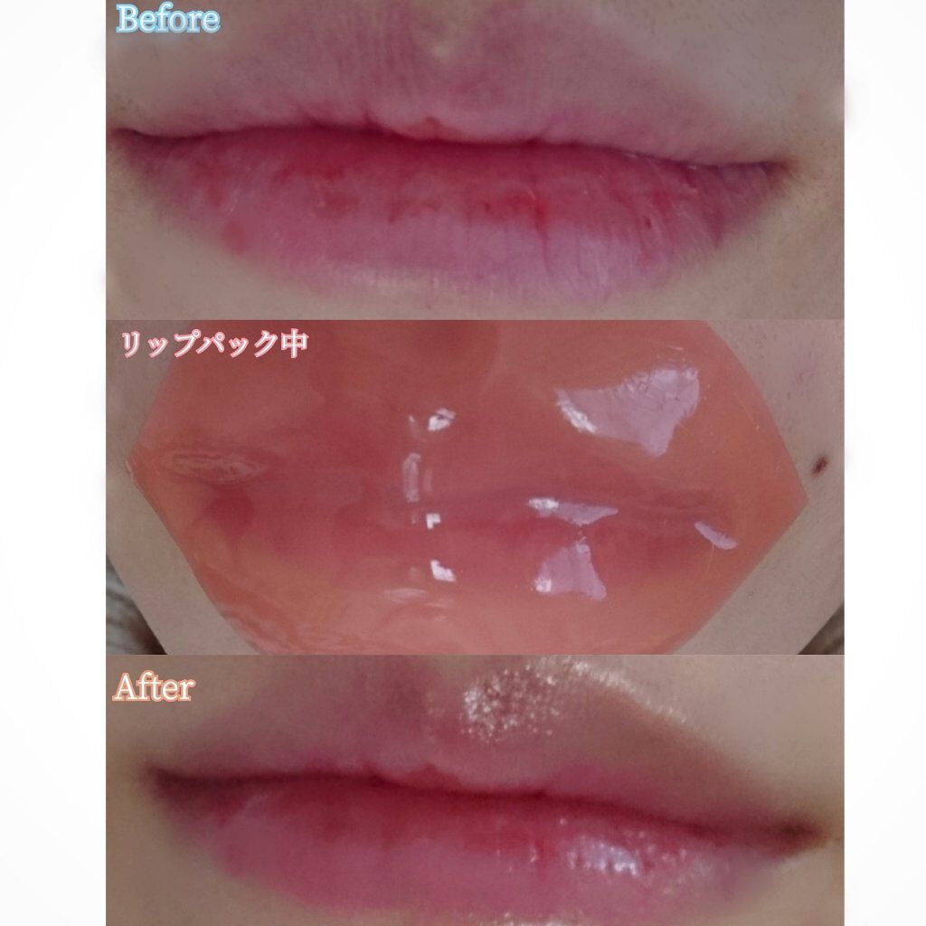 リップパック Choosyの使い方を徹底解説 こんにちは マットティントリップしたり敏感 By 𝐘𝐮𝐊𝐚𝐑𝐢 ブルベ夏 敏感肌 Lips