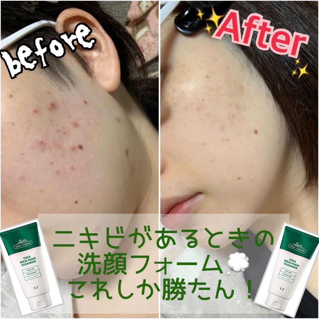 Cica Mild Foam Cleanser Vt Cosmeticsの効果に関する口コミ ニキビケアにおすすめの洗顔フォーム ニキビ撃退 効果のあ By ばにらうさぎ ʚ ɞ 混合肌 代後半 Lips