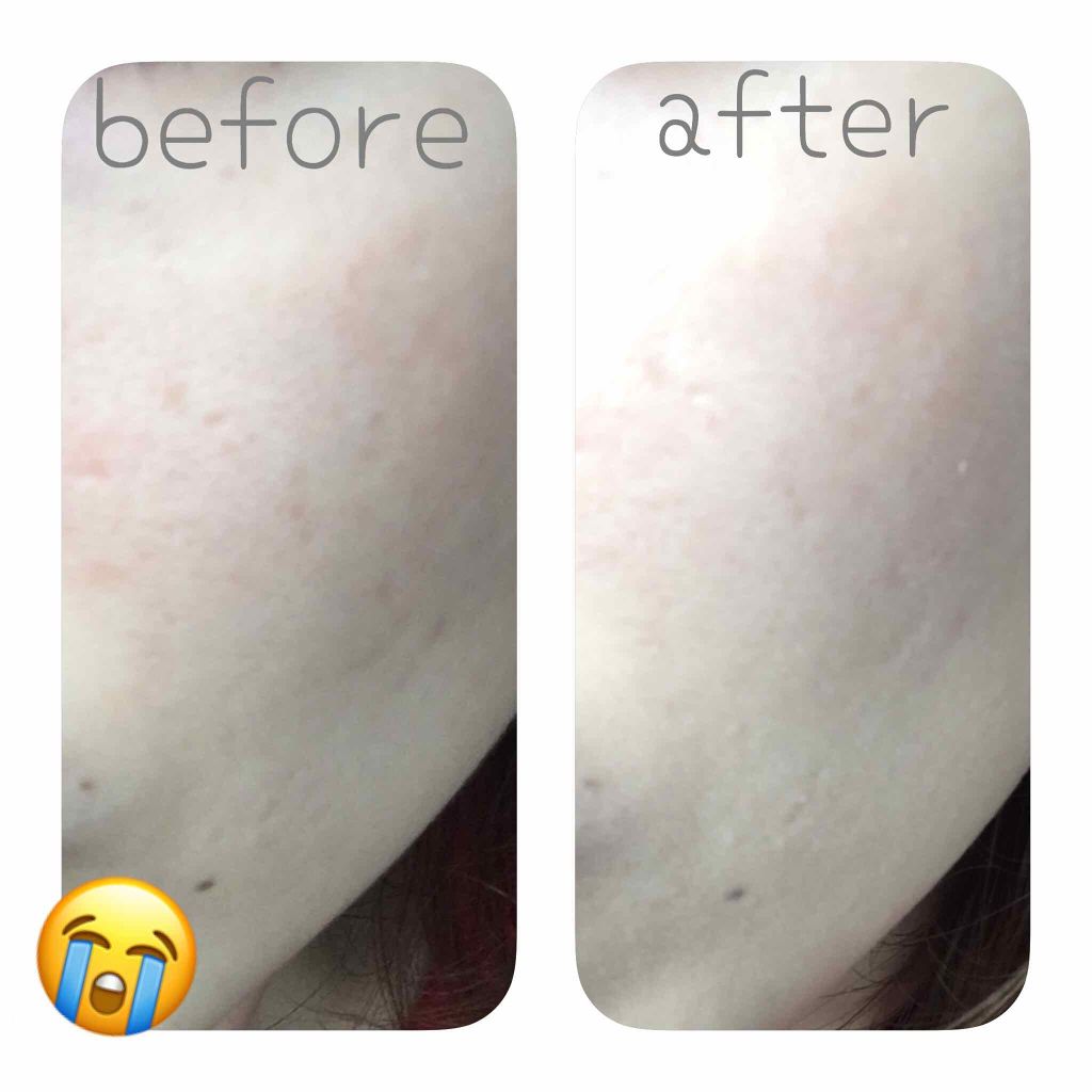 ダブルラスティング セラムファンデーション Etudeの辛口レビュー キンブレを振りすぎて指にペンラダコ が By いちゃこp 混合肌 代前半 Lips