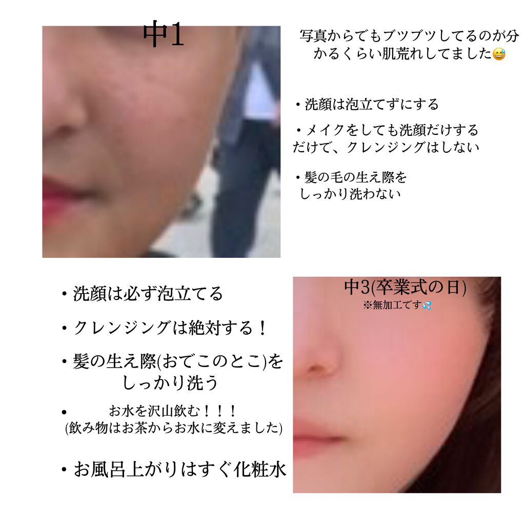 ビタミンc ハードカプセル Dhcを使った口コミ ニキビ肌で悩んでる子集合 私が実際 By 유랑 脂性肌 Lips