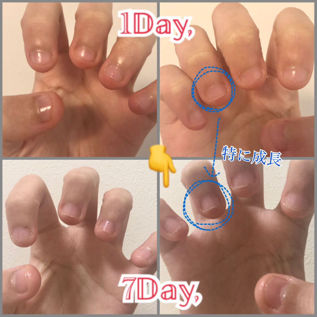 ハンドベール プレミアムリッチネイル メンソレータムを使った口コミ 爪噛まない 毟らない生活7日間達成 爪噛む By れもん 乾燥肌 10代後半 Lips