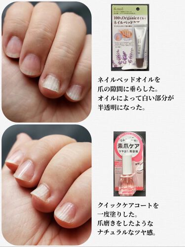 クイックケアコート Ettusaisを使った口コミ お見苦しい画像があります 重度の爪甲剥離 By かぴめろん 乾燥肌 40代後半 Lips