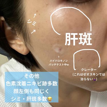 ミラミックス Zo Skin Healthを使った口コミ 画像4枚目閲覧注意 ついにこの日がやってき By ワタクシ ブルベ冬 敏感肌 30代前半 Lips