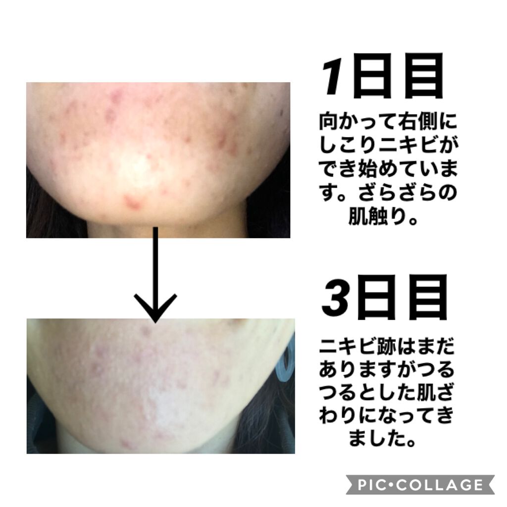 スキンケア方法 エピデュオゲルの使い方 効果 今まで色々なスキンケア By Sky 混合肌 30代後半 Lips