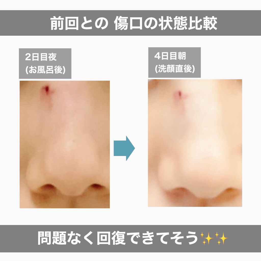 キズパワーパッド バンドエイドの口コミ 顔の傷へキズパワーパッドを貼り直して約1 By Djきょろ 乾燥肌 30代後半 Lips