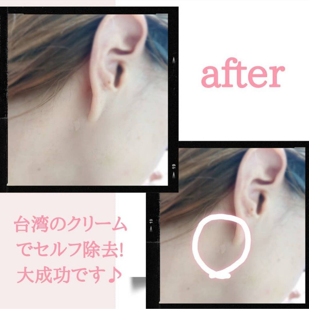 キズパワーパッド バンドエイドの使い方を徹底解説 約１センチの巨大ホクロ除去を自分でやりまし By Maiasagi Lips