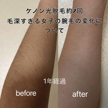 家庭用脱毛器 ケノン Ke Non エムテックの口コミ 毛深すぎる女子の腕毛記録 需要ありです笑 By Ria フォロバ 混合肌 10代後半 Lips