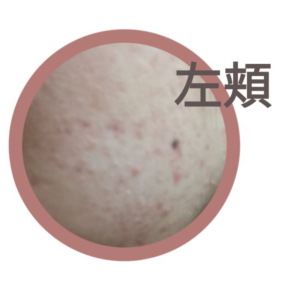 マルチビタミン 栄養機能食品 ビタミンb1 ビタミンc ビタミンe Dhcを使った口コミ 肌荒れとニキビに悩む高校生です 3日目 By ちーちょ 脂性肌 10代後半 Lips