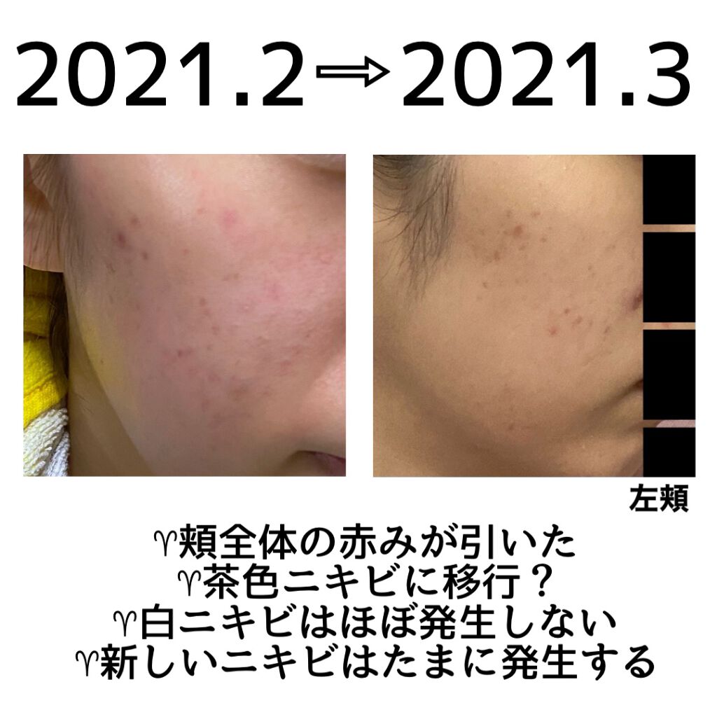 Me レギュラー 4 Ipsaを使った口コミ ベピオゲルを使用して約1年半 薬だけじゃ全 By ひつち 混合肌 Lips