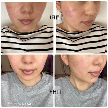 プリスクリードd 医薬品 Ihadaの使い方を徹底解説 先日 赤みに効くと記事をみて親切に使用方法 By Mei Mama 敏感肌 代後半 Lips