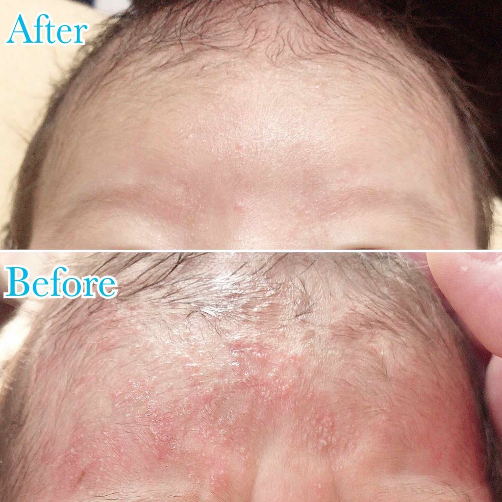 ミルクローション アロベビーの口コミ ベビが1ヶ月を迎え 乳児湿疹が酷くて悩んで By Huis 乾燥肌 30代前半 Lips
