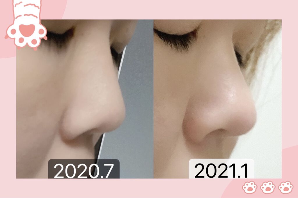 お鼻リフォーマー ハナハナ グッズマンの口コミ 鼻の成長記録2 今回は正面から向いた By ねこたらし 乾燥肌 代前半 Lips