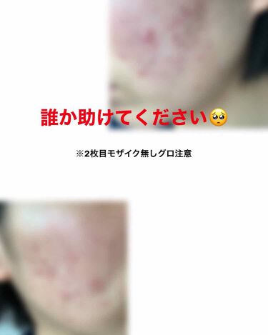 薬用ニキビケア ウォッシングフォーム 思春期用 アクネスラボのリアルな口コミ レビュー Lips