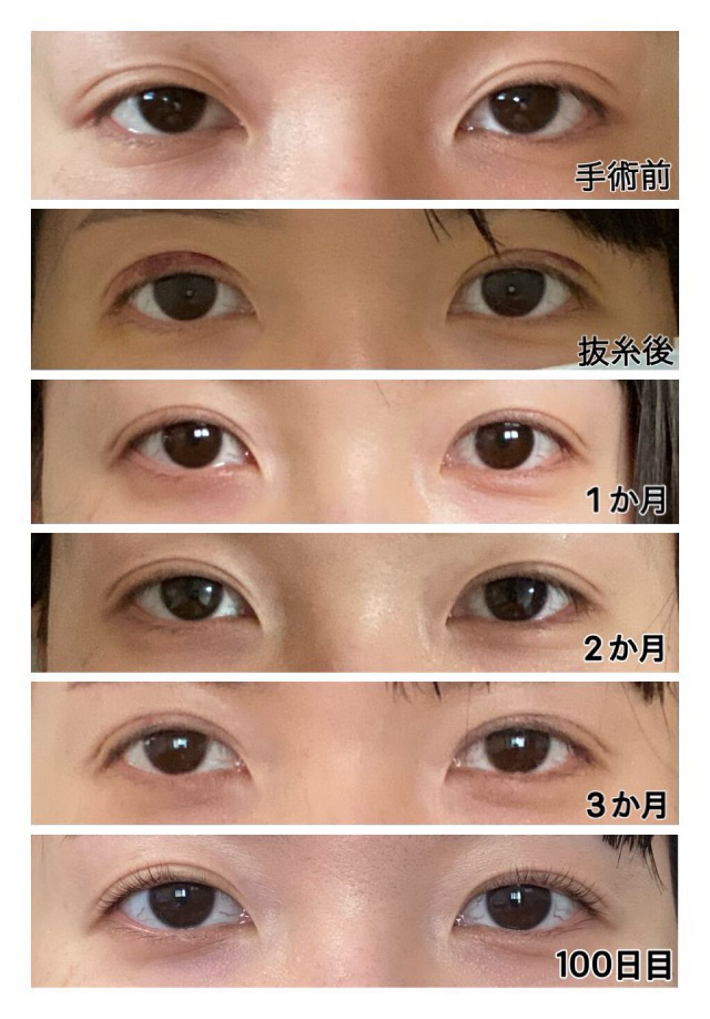 二重整形の口コミ みなさんお久しぶりです 今日ちょうど10 By Mimi 乾燥肌 代後半 Lips